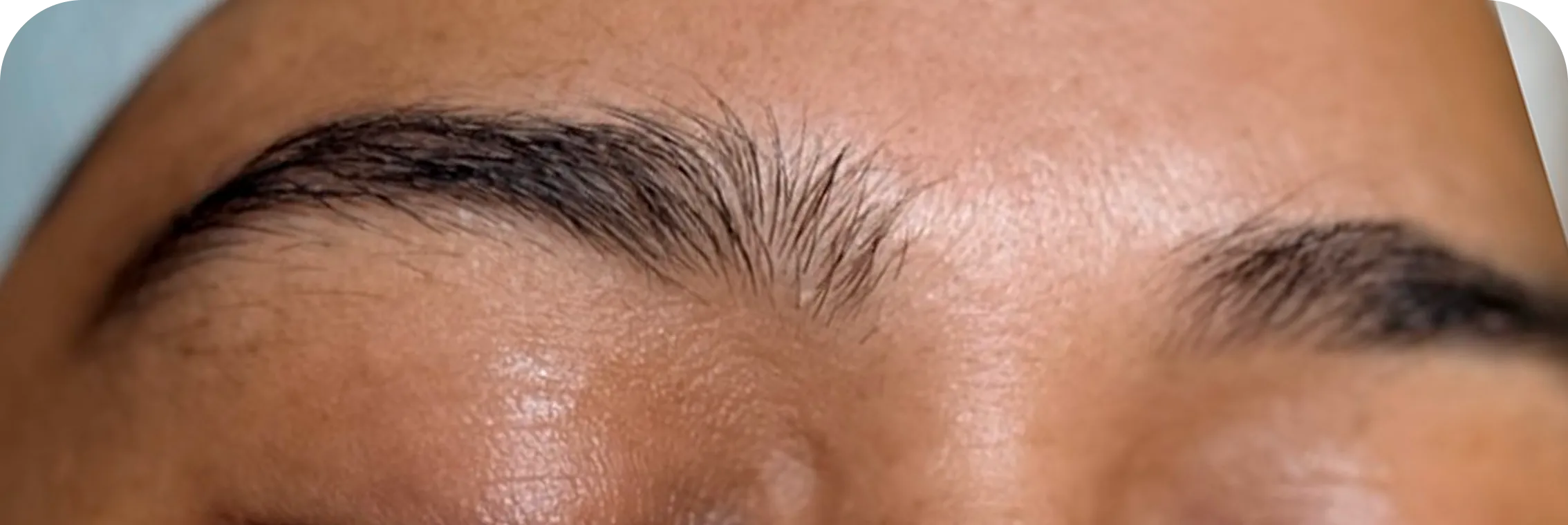 Cejas, caso 1: antes del tratamiento.
