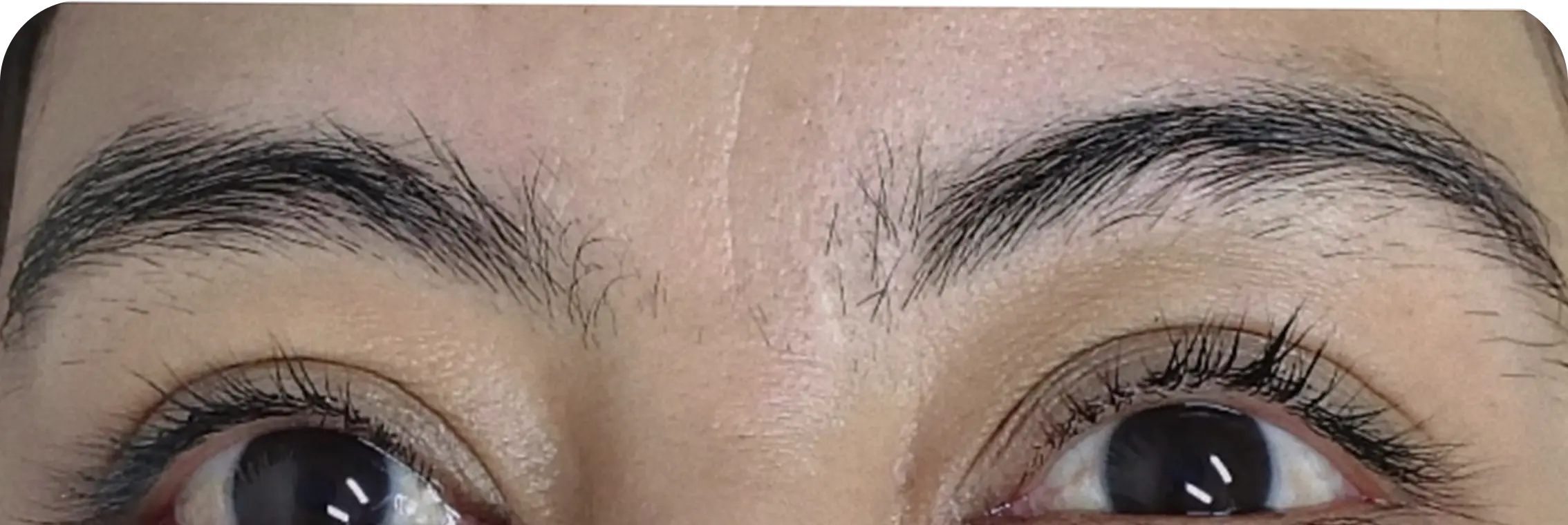 Cejas, caso 2: antes del tratamiento.